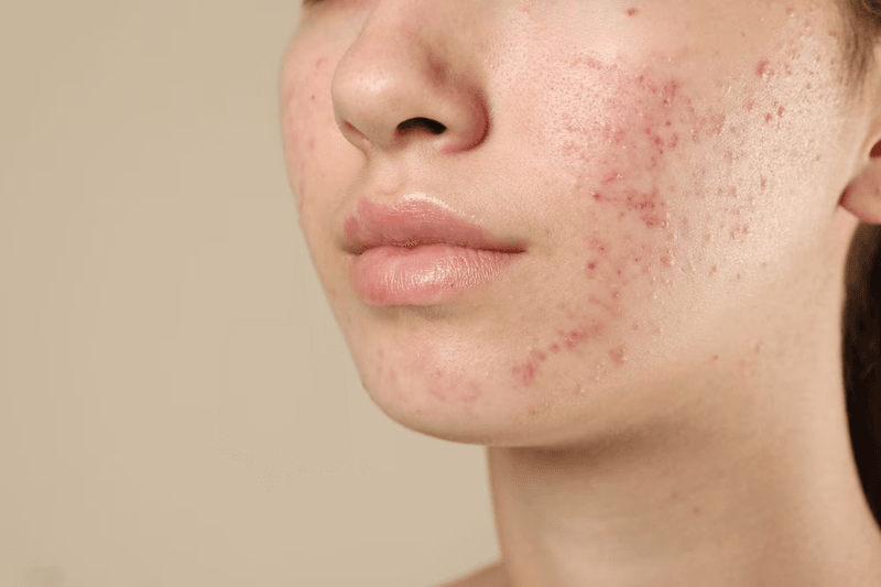 acne condition image