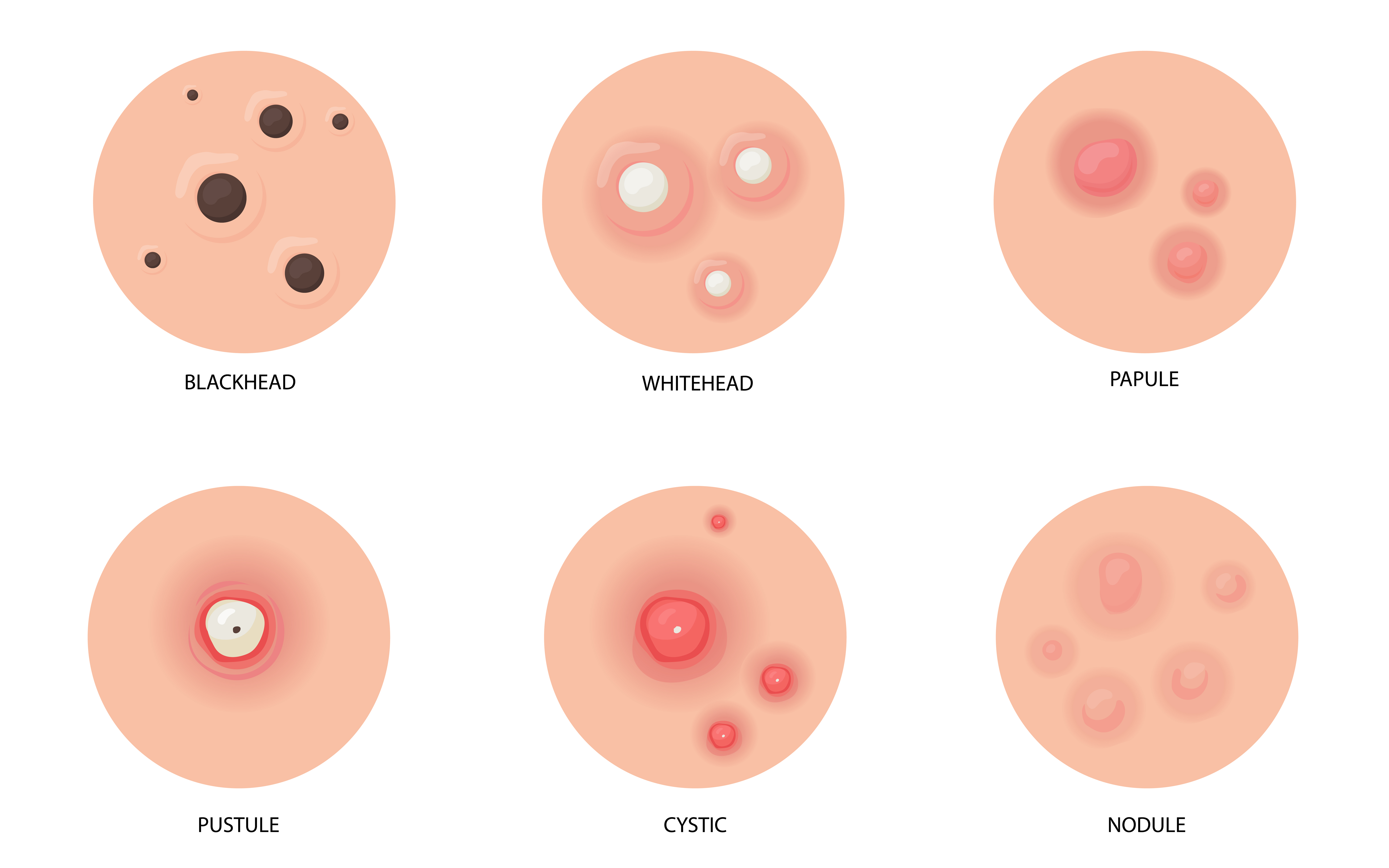 types of acne.jpg