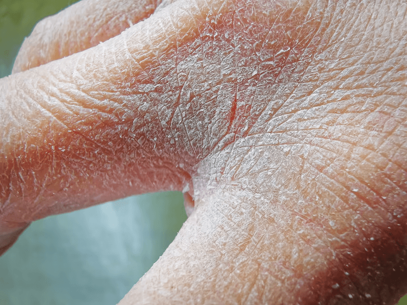 Dry, Cracking Skin image 1
