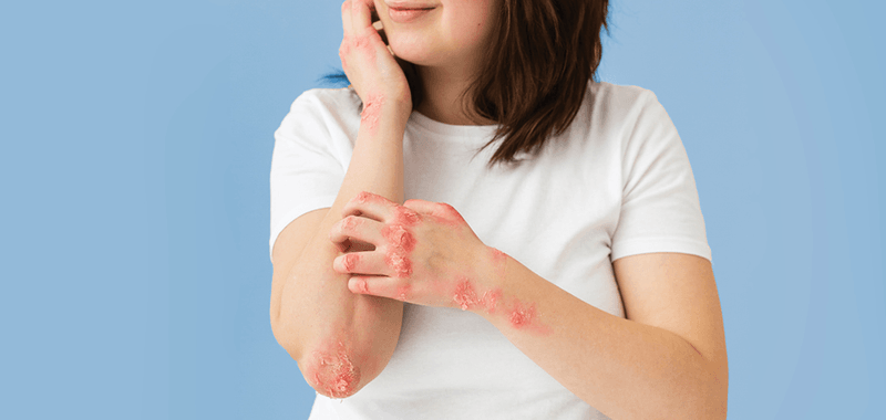 Eczema / Psoriasis with Corticosteroids image 2