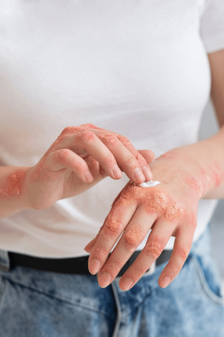 Eczema / Psoriasis with Corticosteroids image 1