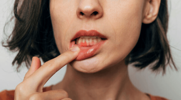 oral mucositis condition image