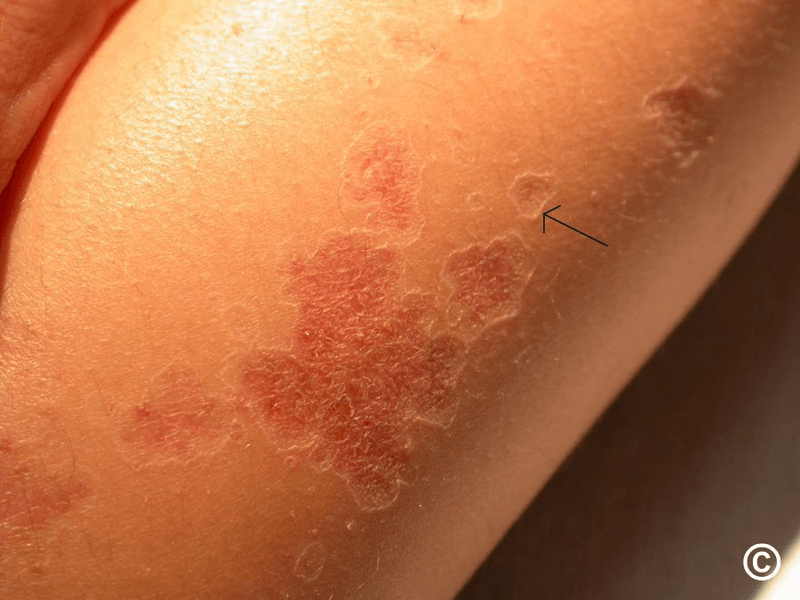 Porokeratosis image 2