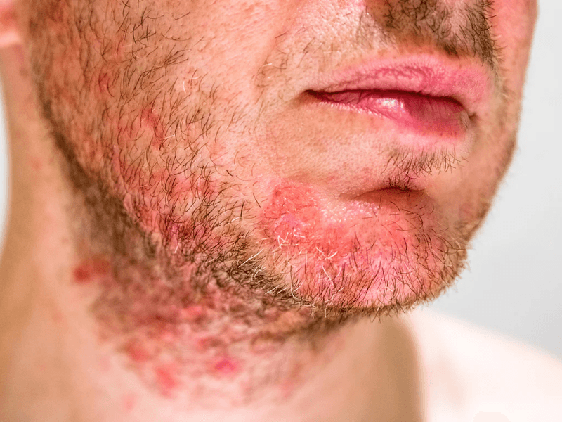 Seborrheic Dermatitis image 2