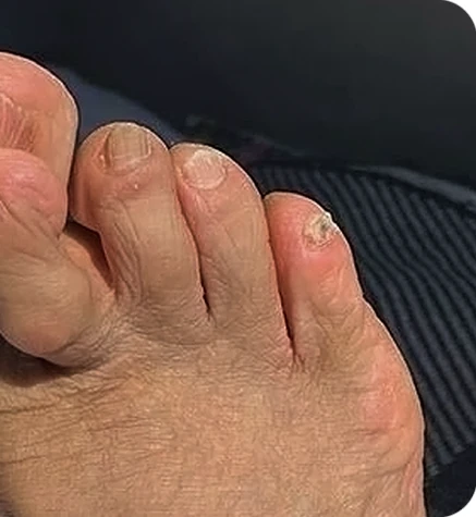 Nail Fungus Treatment — after