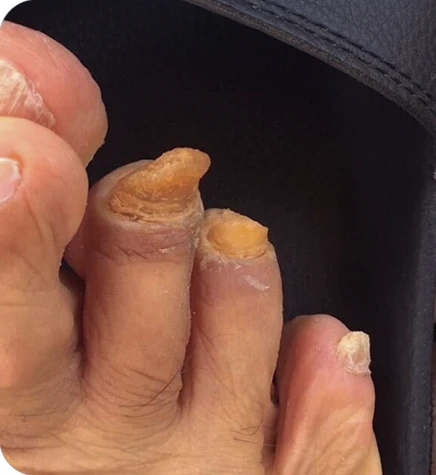 Nail Fungus Treatment — before