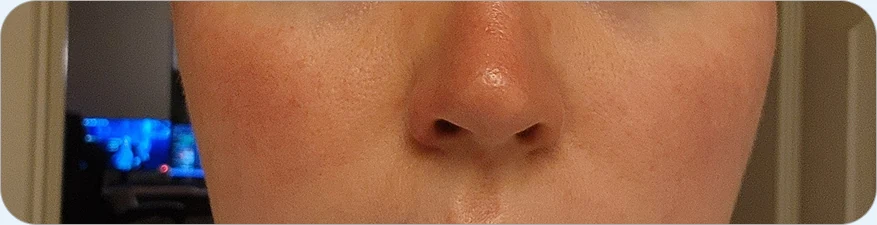 Rosacea & Acne Overlap Treatment — after