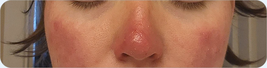 Rosacea & Acne Overlap Treatment — before