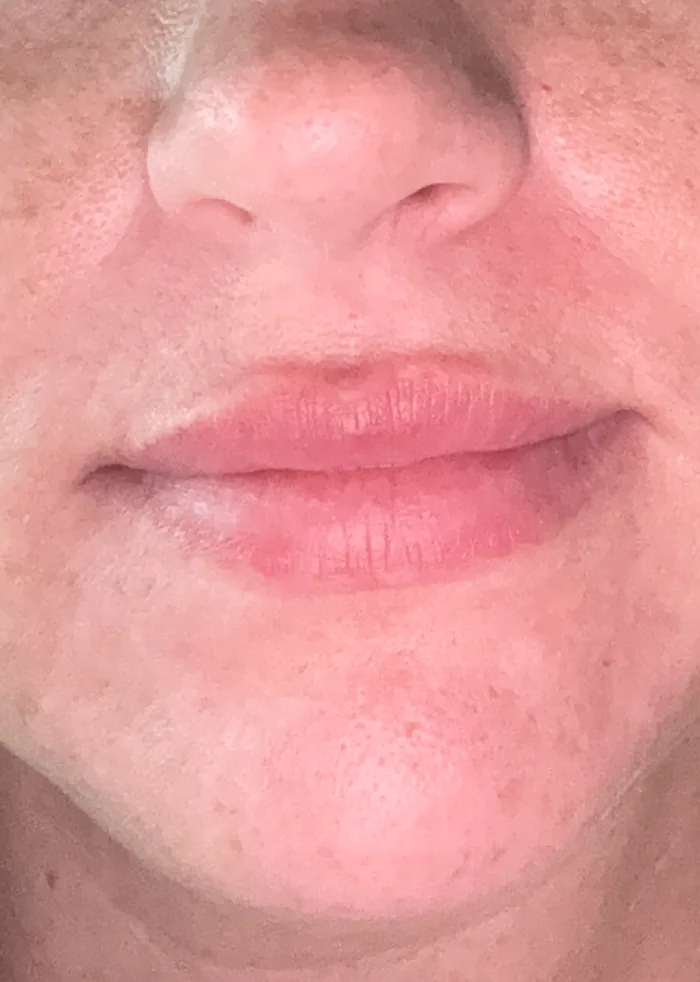Diffuse Facial Redness — after treatment