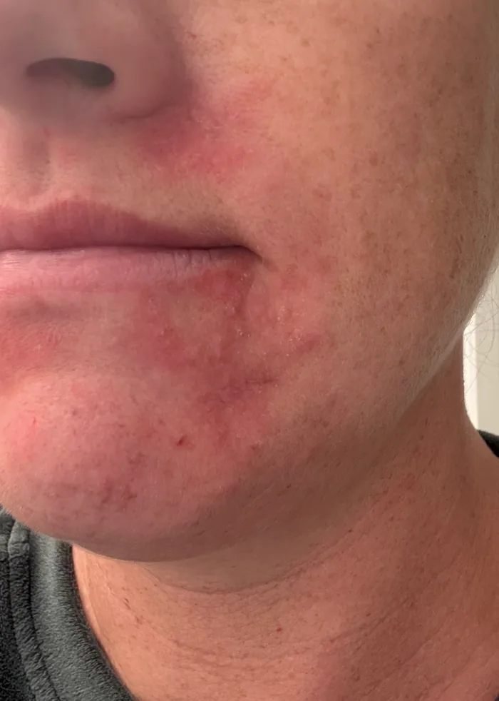 Diffuse Facial Redness — before treatment