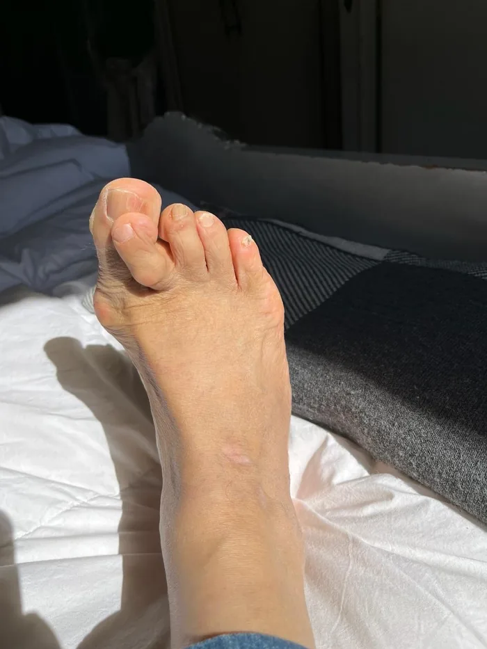 Nail Fungus Treatment — after treatment