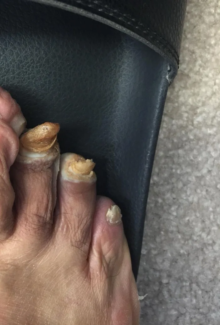 Nail Fungus Treatment — before treatment