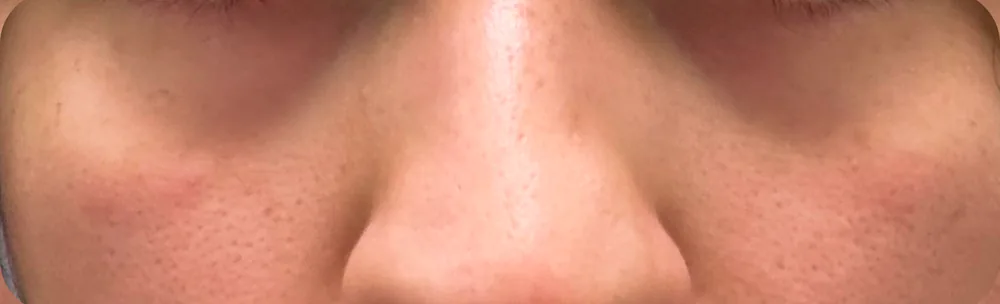 Periorbital Inflammation — after treatment