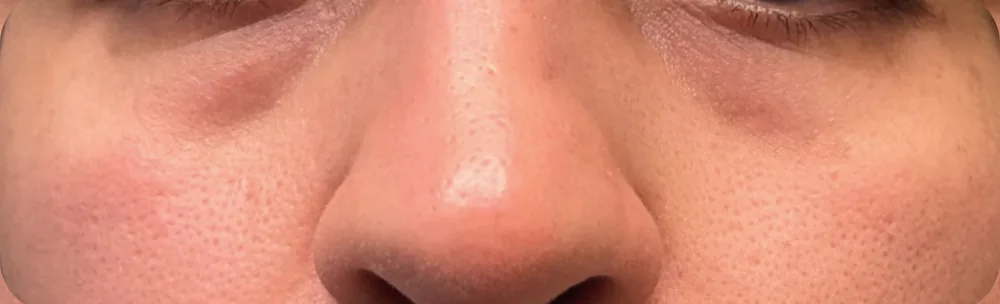 Periorbital Inflammation — before treatment