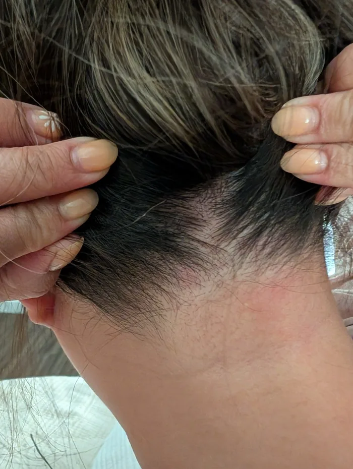 Seborrheic Dermatitis — after treatment