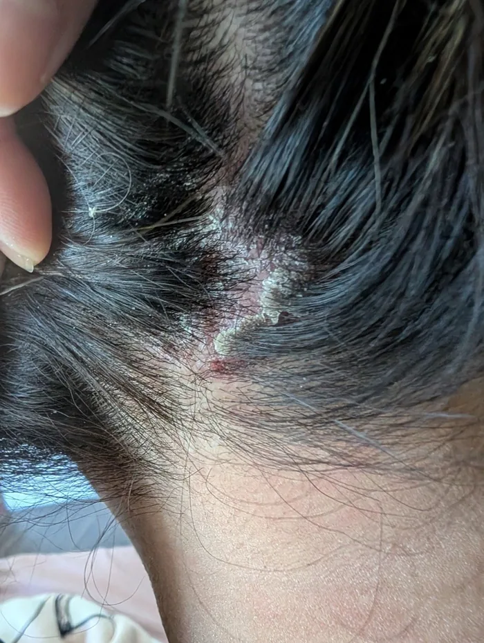 Seborrheic Dermatitis — before treatment