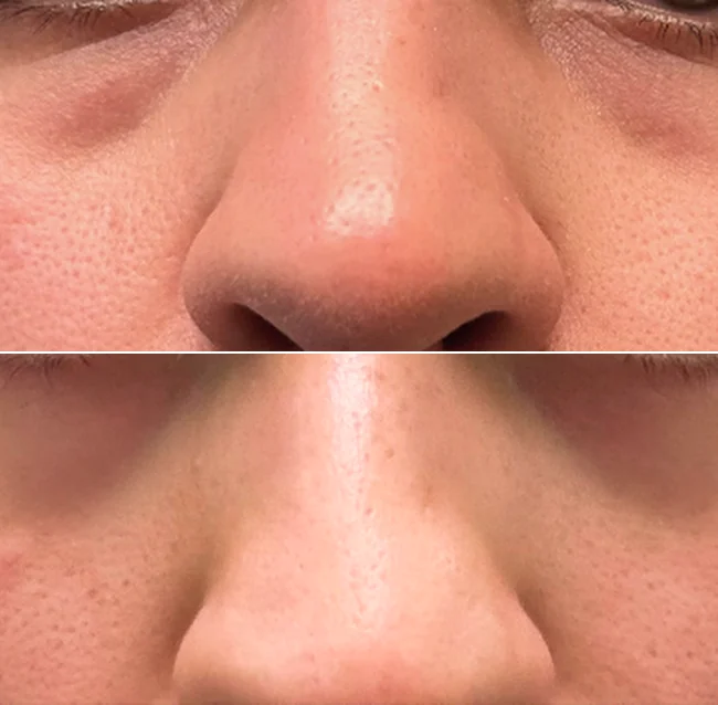 Before and after: visible pores on a patient's nose, then smoother skin