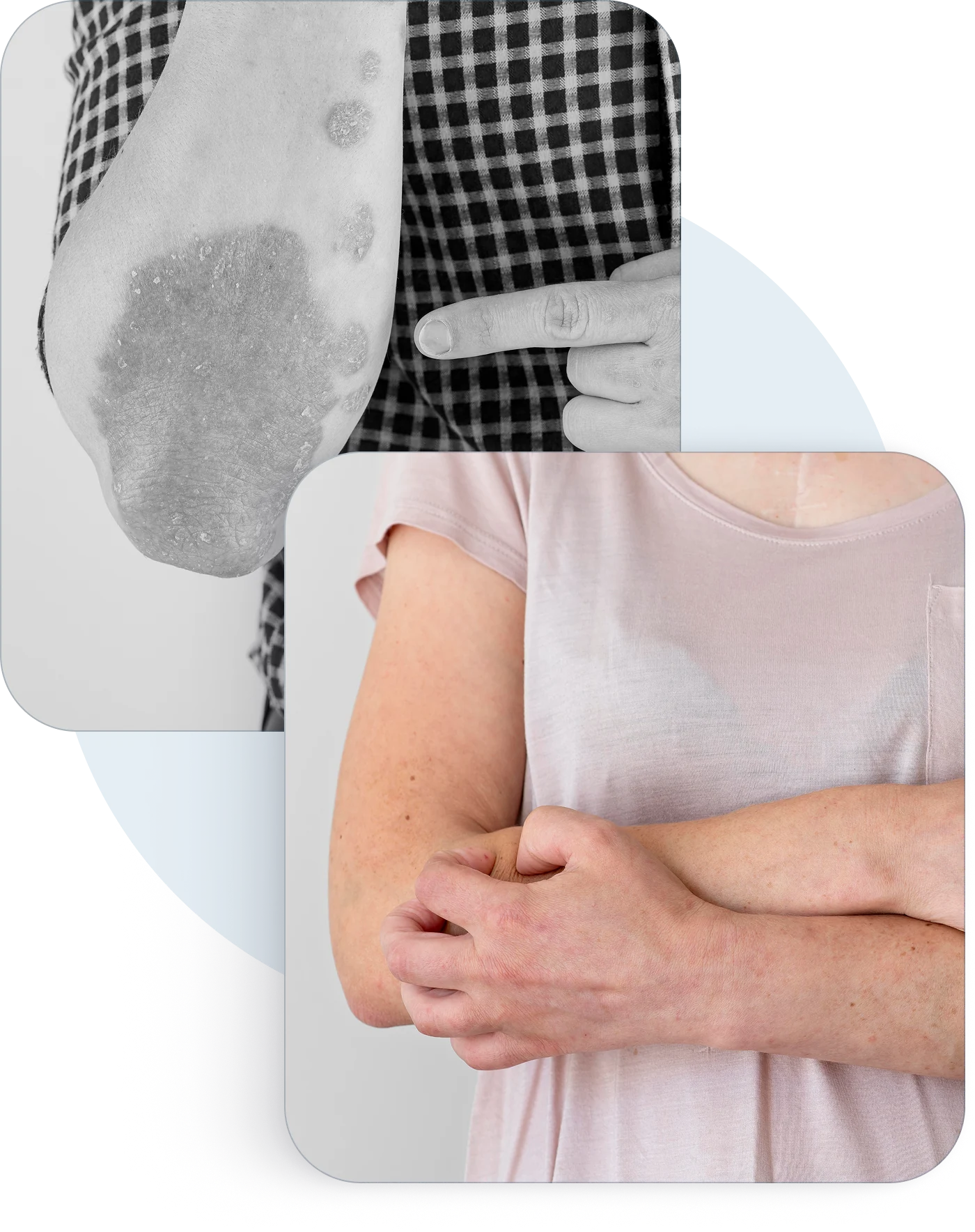 Eczema patches on an elbow and on folded arms