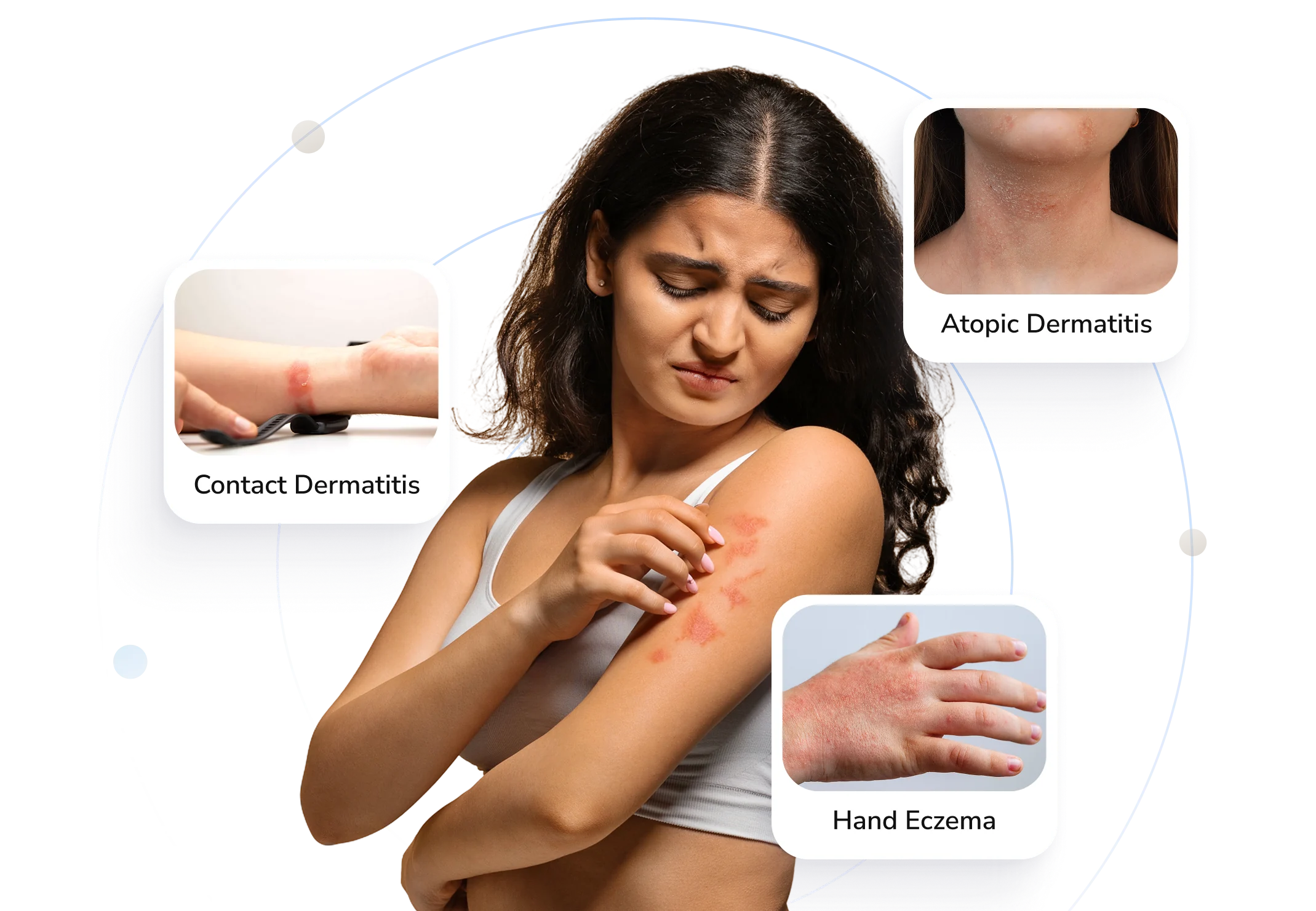 Types of eczema Telederm helps with — contact dermatitis, atopic dermatitis and hand eczema