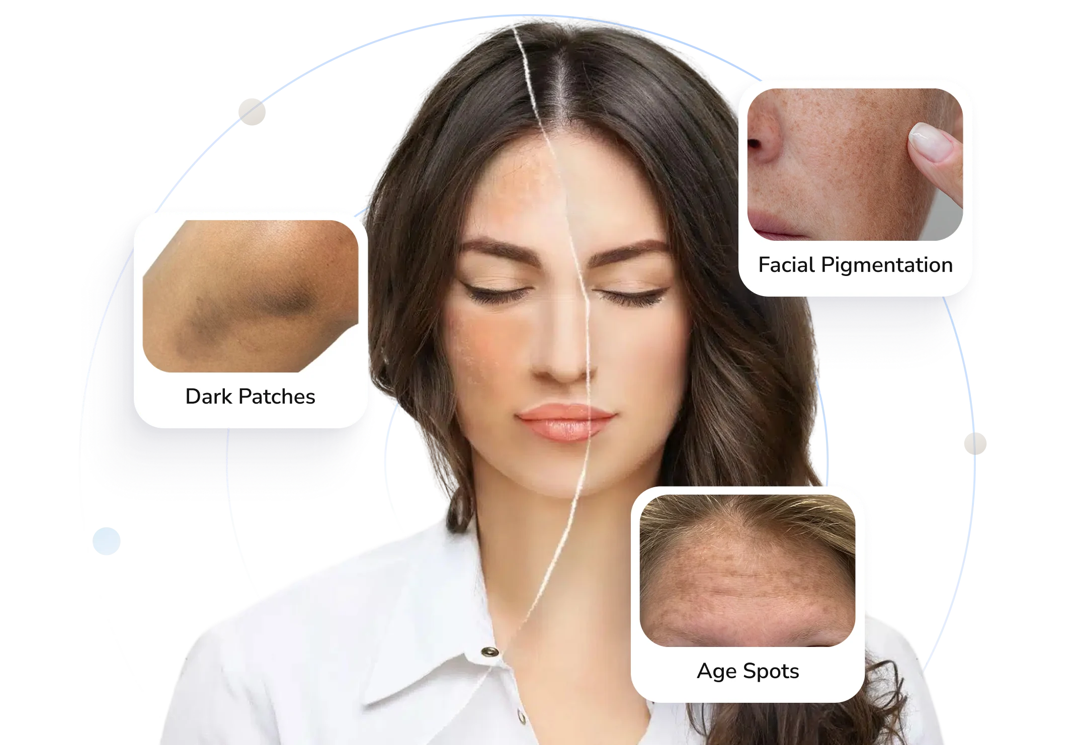 Types of hyperpigmentation Telederm helps with — dark patches, facial pigmentation and age spots