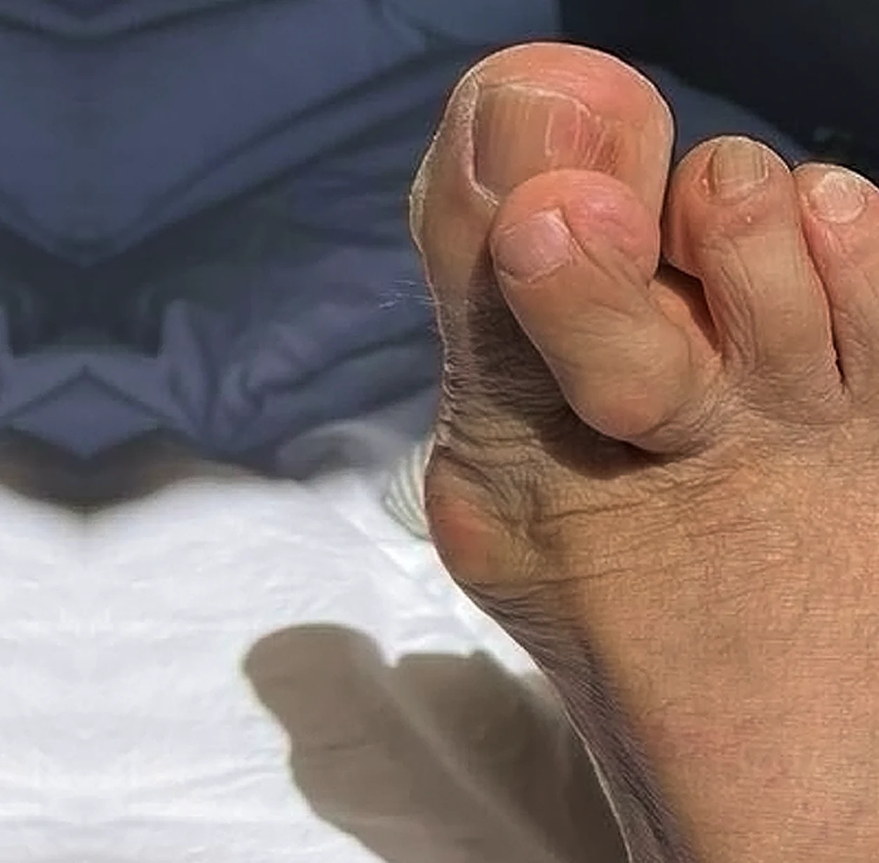 After: the same toes with clearer, healthier nails