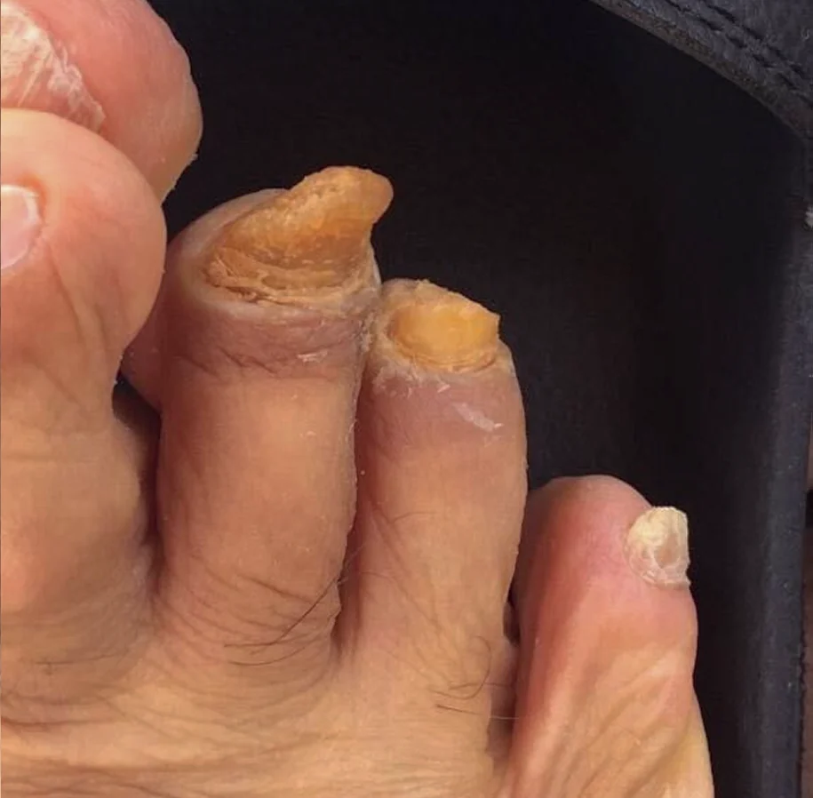 Before: a thickened, discolored toenail
