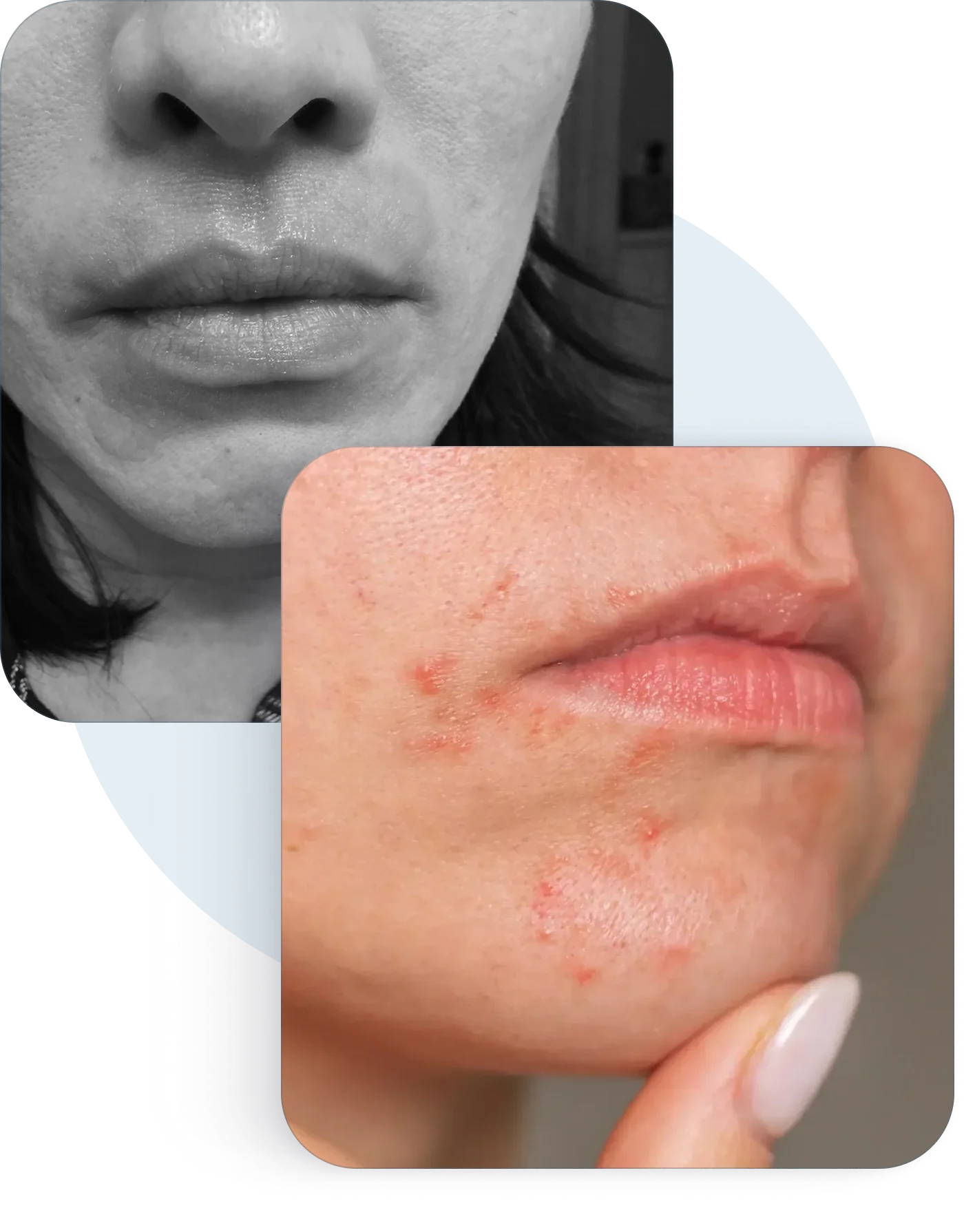Small red bumps around the mouth and chin