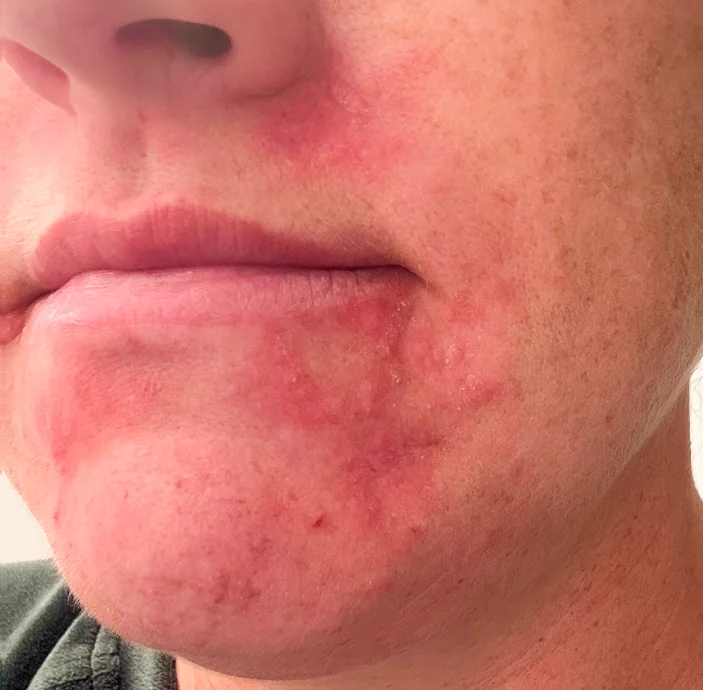 Before: a red rash around a patient's mouth and chin