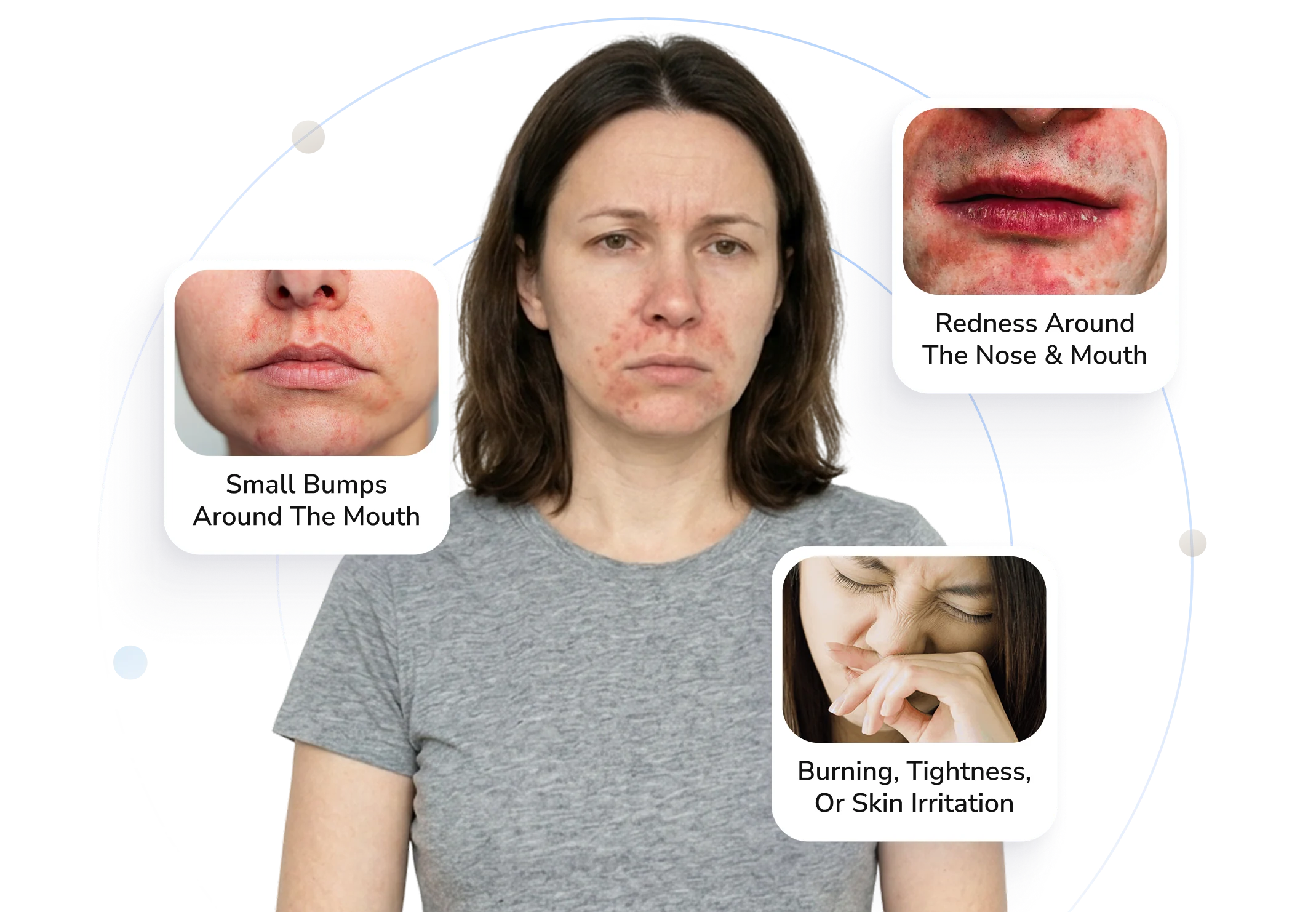 Perioral dermatitis symptoms Telederm helps with — bumps, redness and irritation around the mouth