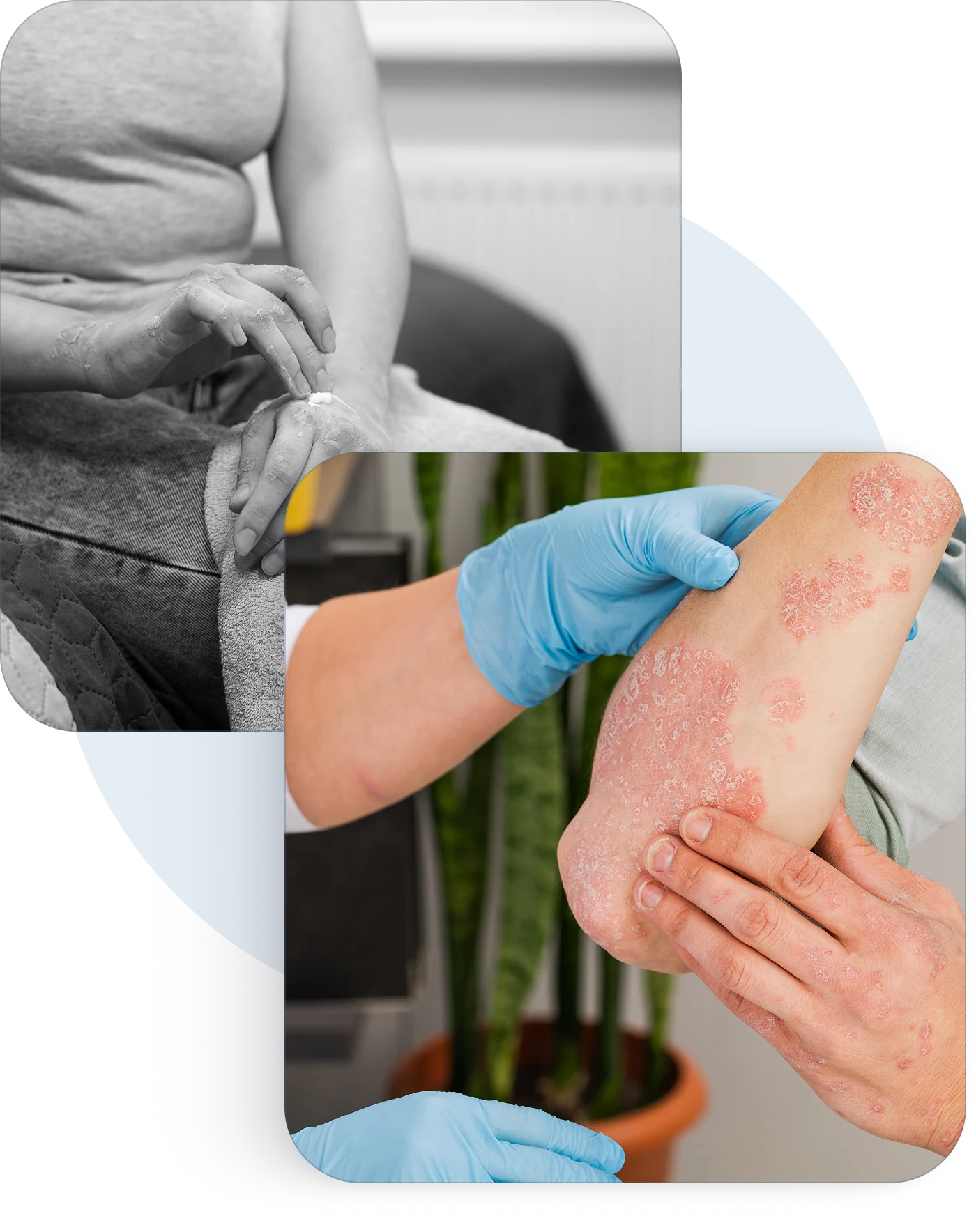 A patient with psoriasis plaques on the arm being examined by a clinician