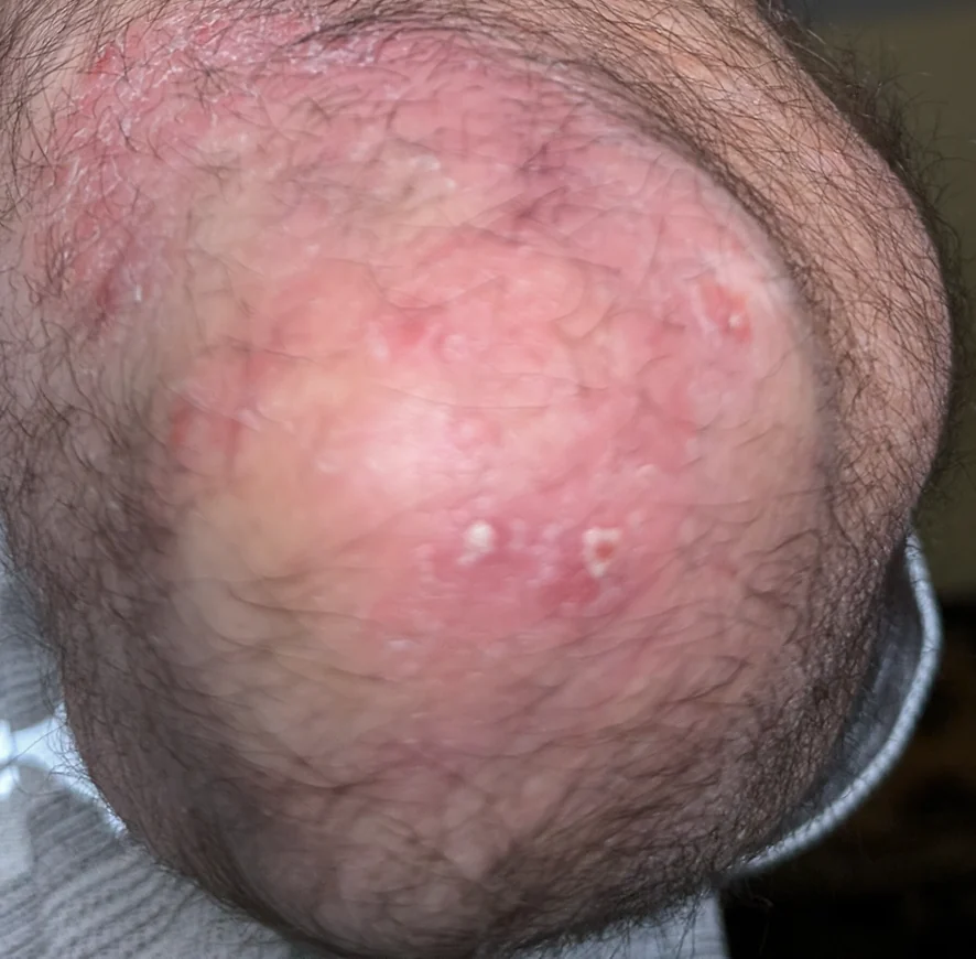 After: the same elbow, smoother with the scaling cleared