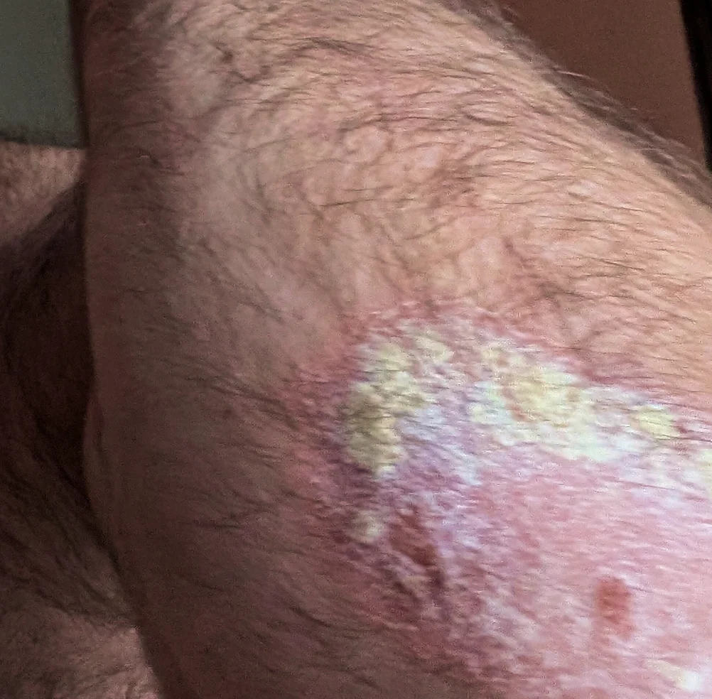 Before: a thick, scaly psoriasis plaque on a patient's elbow