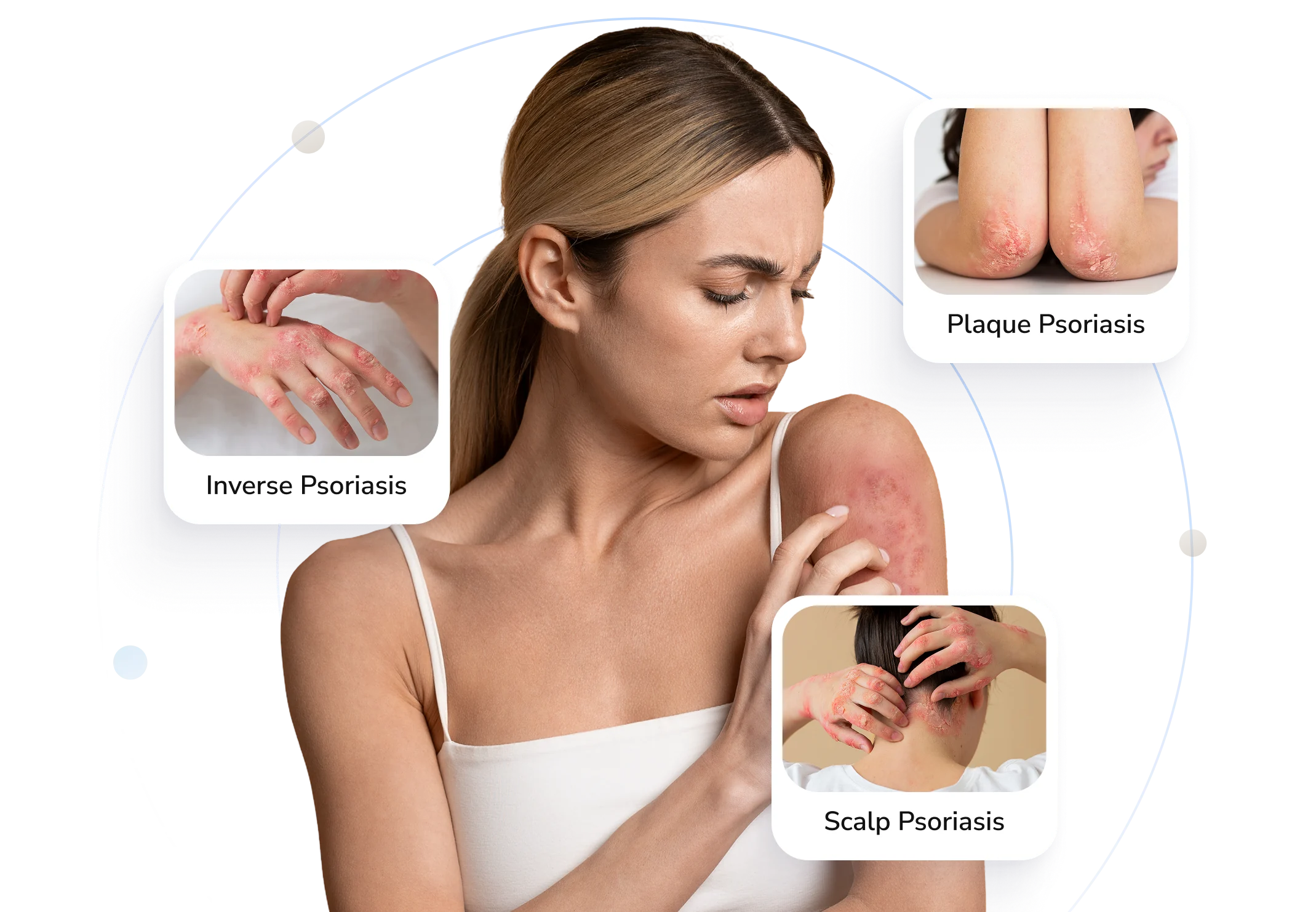 Types of psoriasis Telederm helps with — inverse, plaque and scalp psoriasis