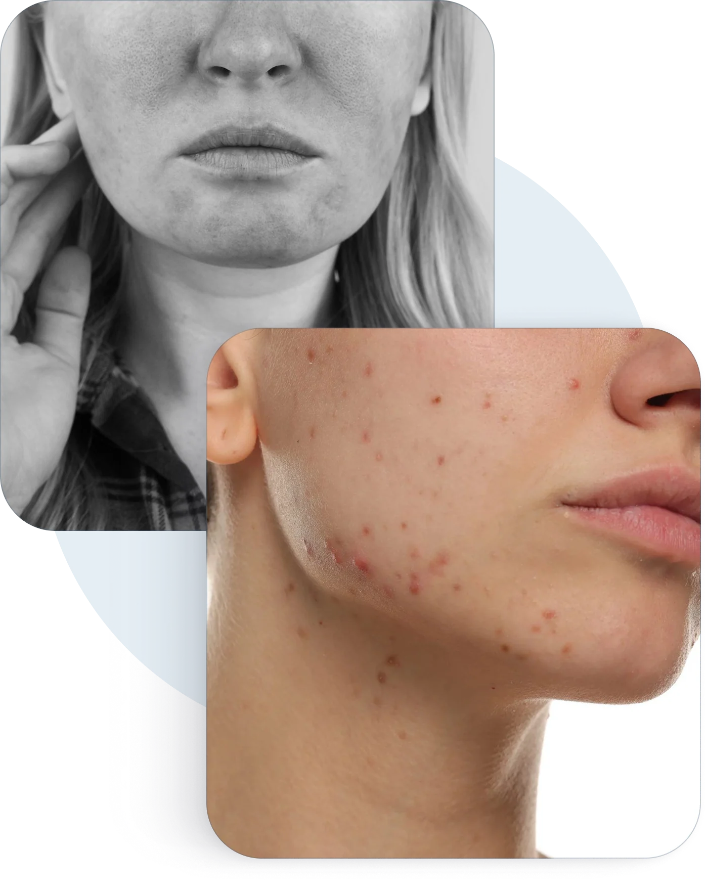 Facial redness and bumps on the cheeks and jaw