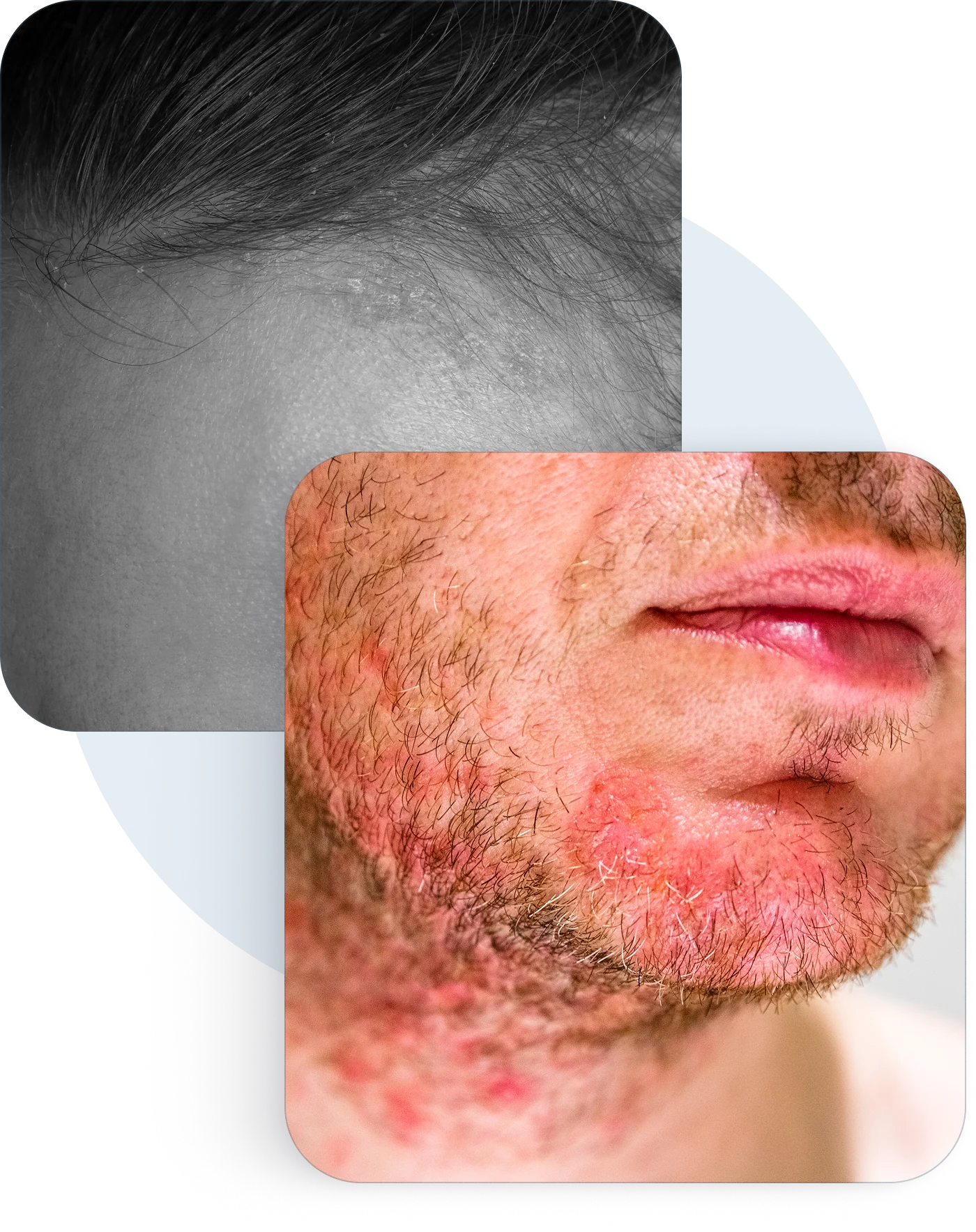 Flaky, irritated skin along a hairline and around a mouth