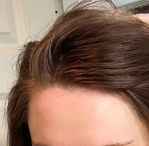 After: the same hairline, calm and clear