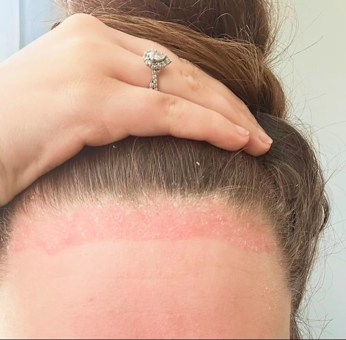 Before: red, flaky skin along a patient's hairline