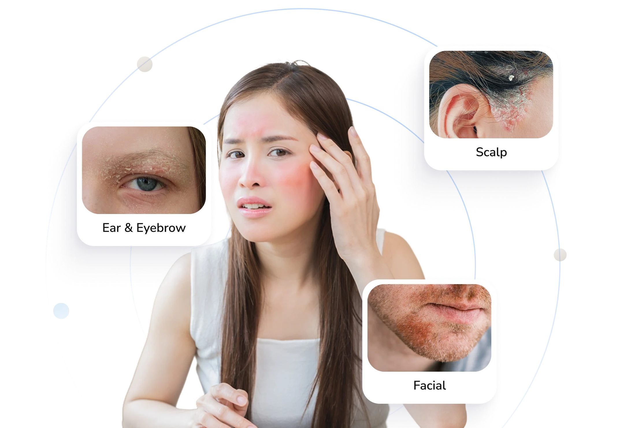 Types of seborrheic dermatitis Telederm helps with — ear and eyebrow, scalp and facial