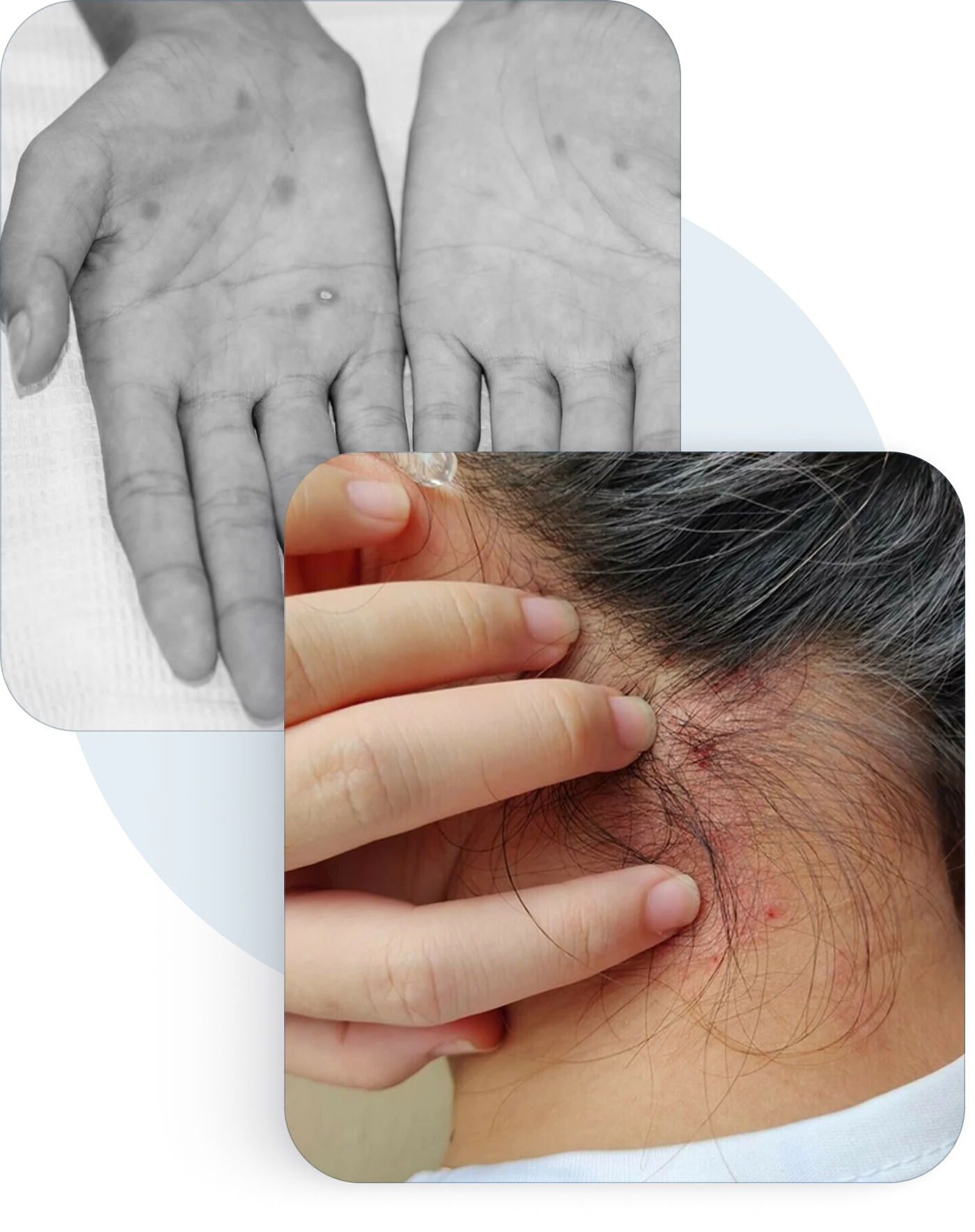 Irritated, infected skin on the hands and neck
