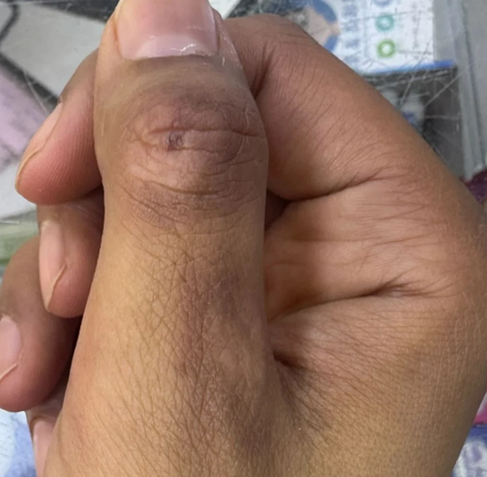 After: the same patient's hand with the warts cleared
