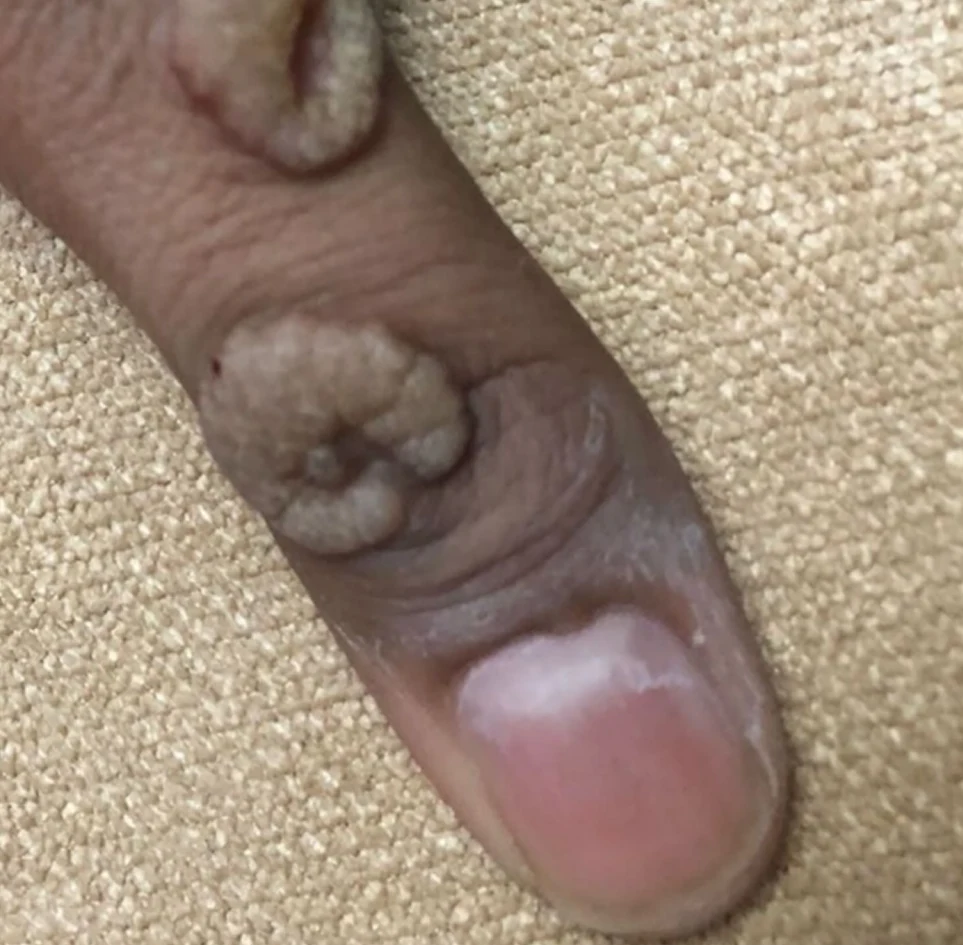 Before: a patient's finger with several raised common warts
