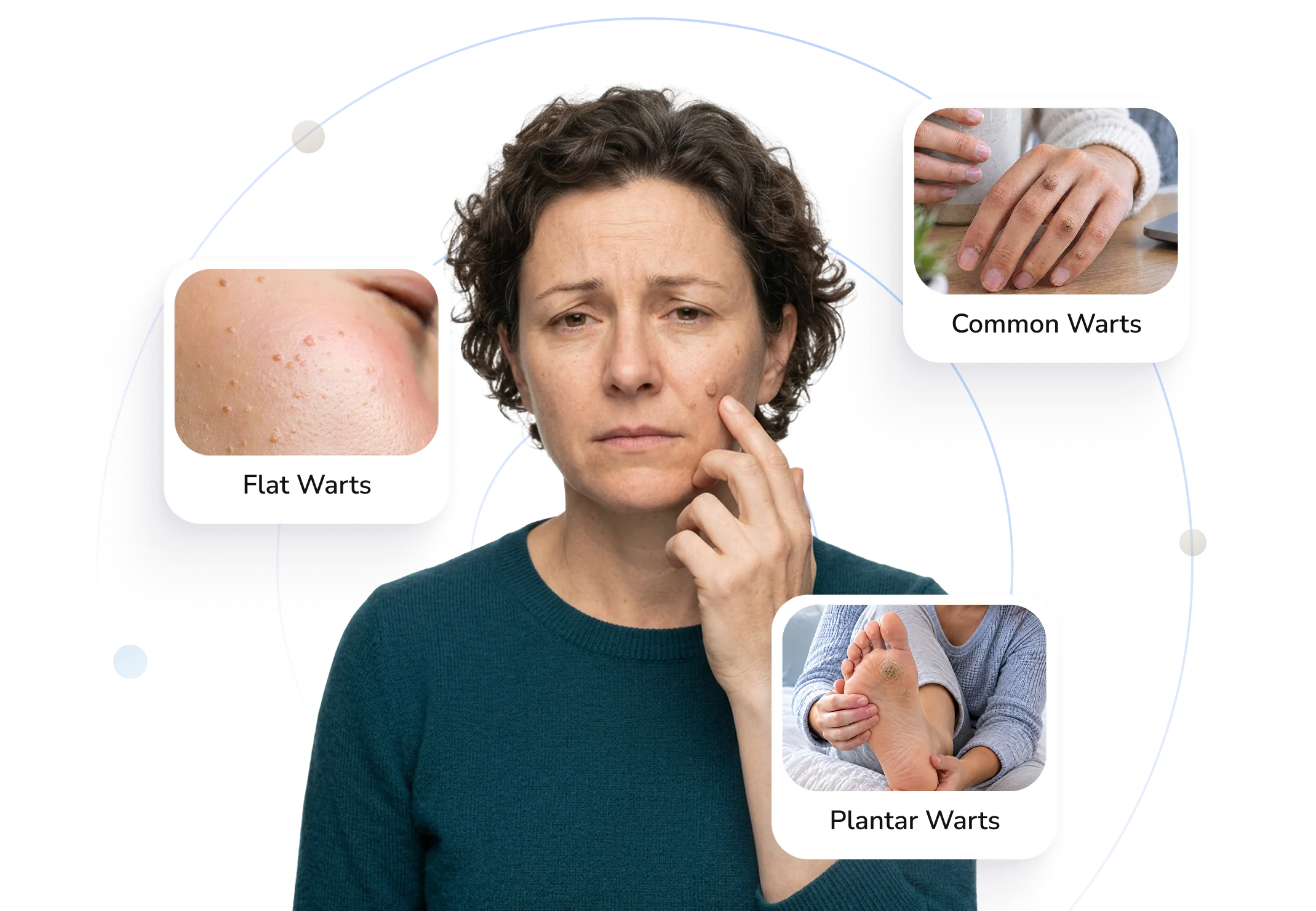 Types of warts Telederm helps with — flat, common and plantar warts