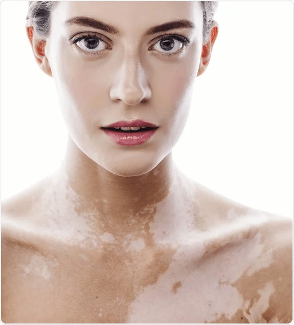 Skin Bleaching image 2