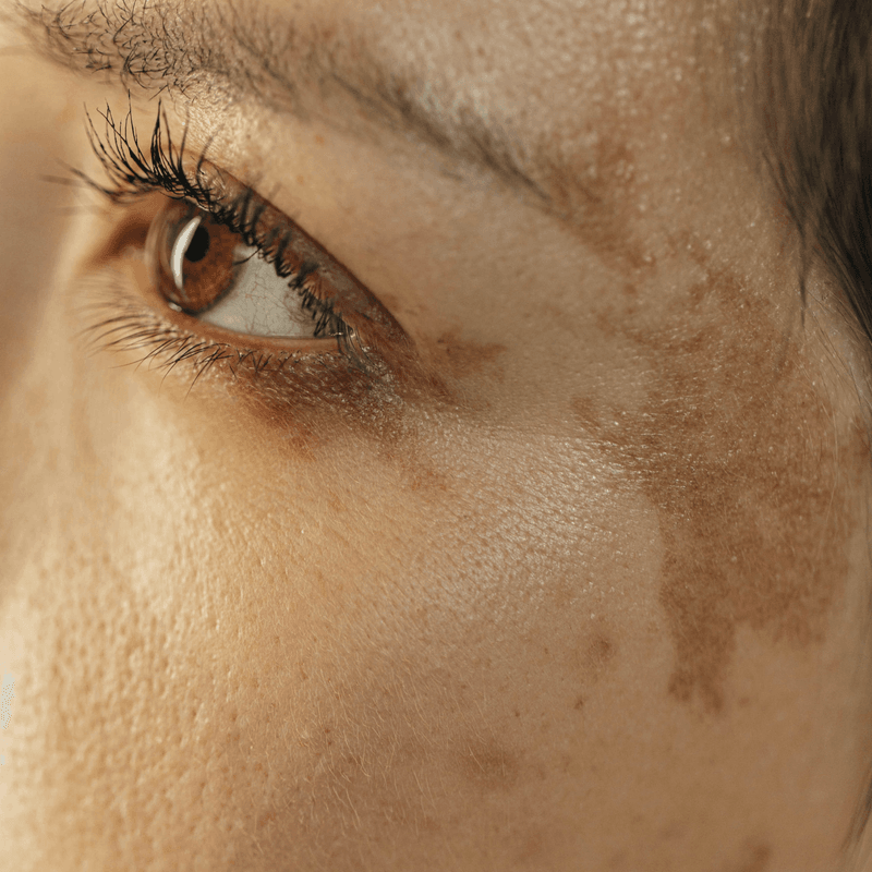 Skin Bleaching image 3