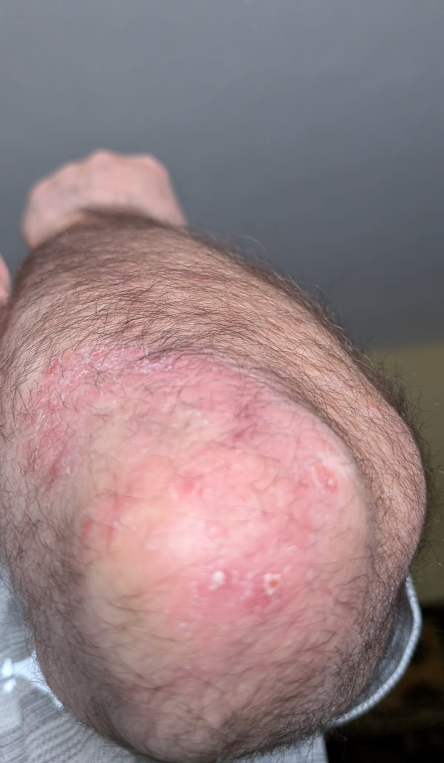 Psoriasis Treatment — after