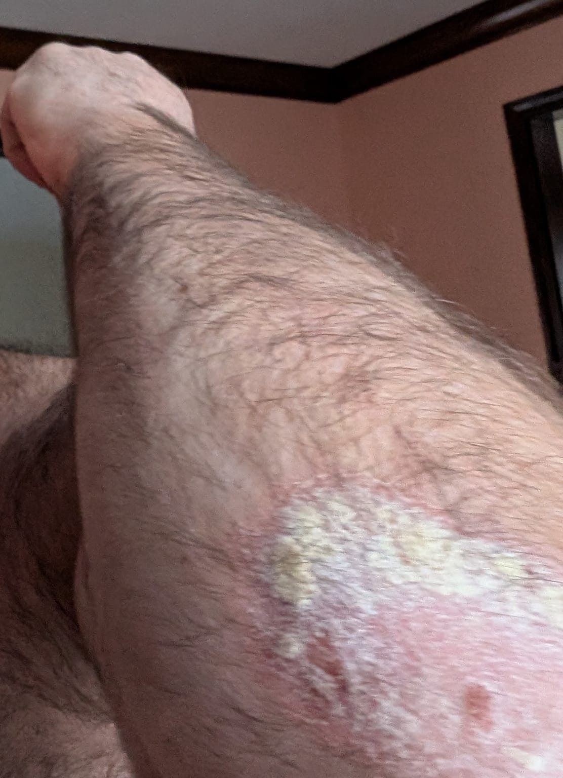 Psoriasis Treatment — before
