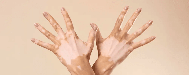 Vitiligo image 2