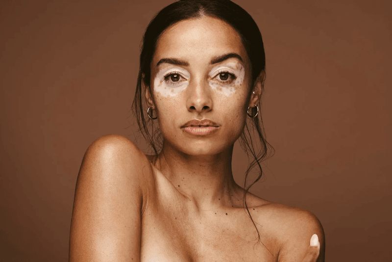 Vitiligo image 1